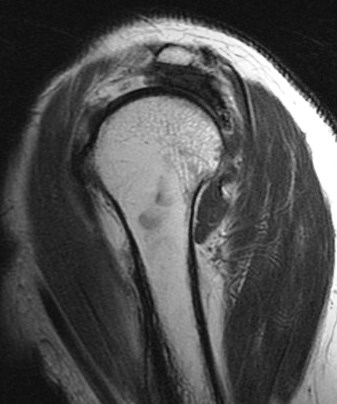 Figure 4 for case HAGL lesion and rotator cuff tears